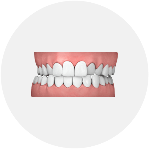 common-cases-crossbite