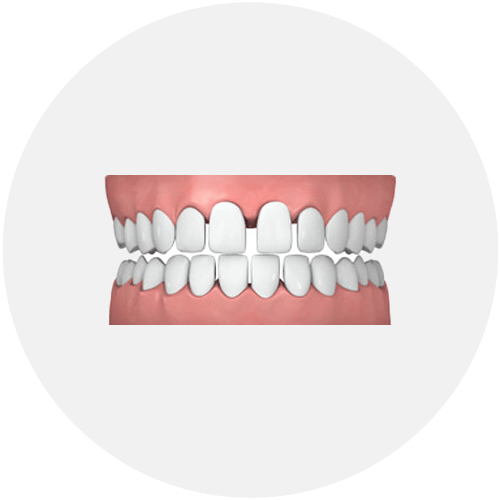 common-cases-gapped-teeth