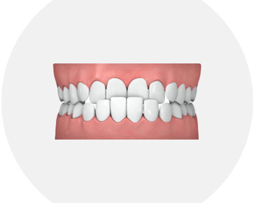 common-cases-underbite