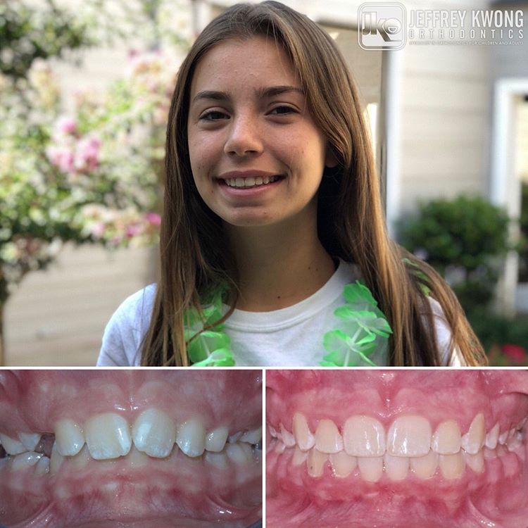 teen age girl teeth Image