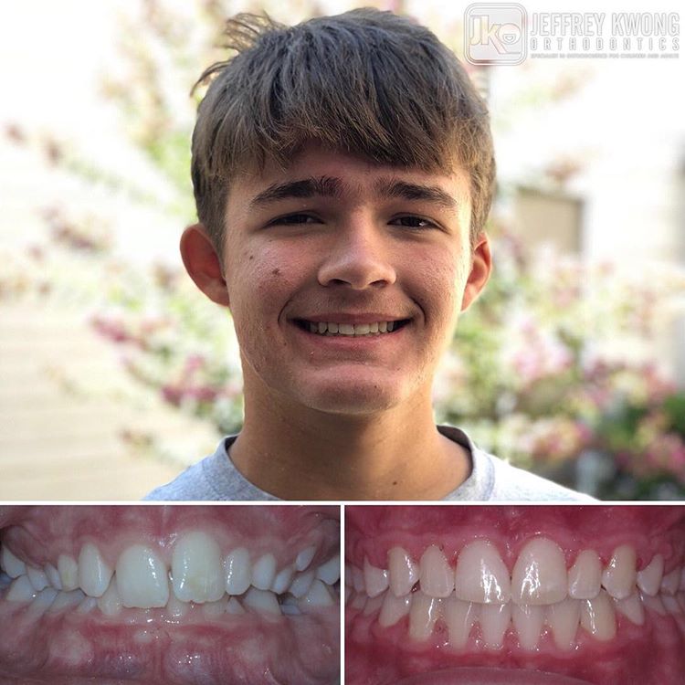 teen age boy with teeth