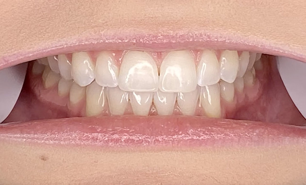 Front Teeth