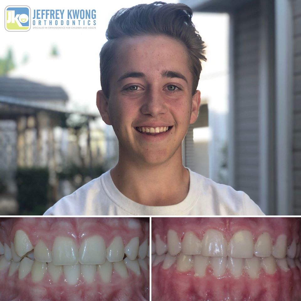 teen with clear aligners