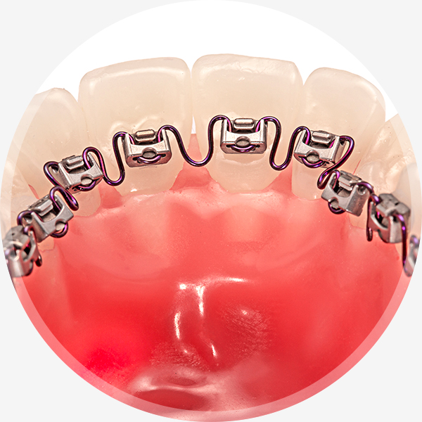 invisible braces example