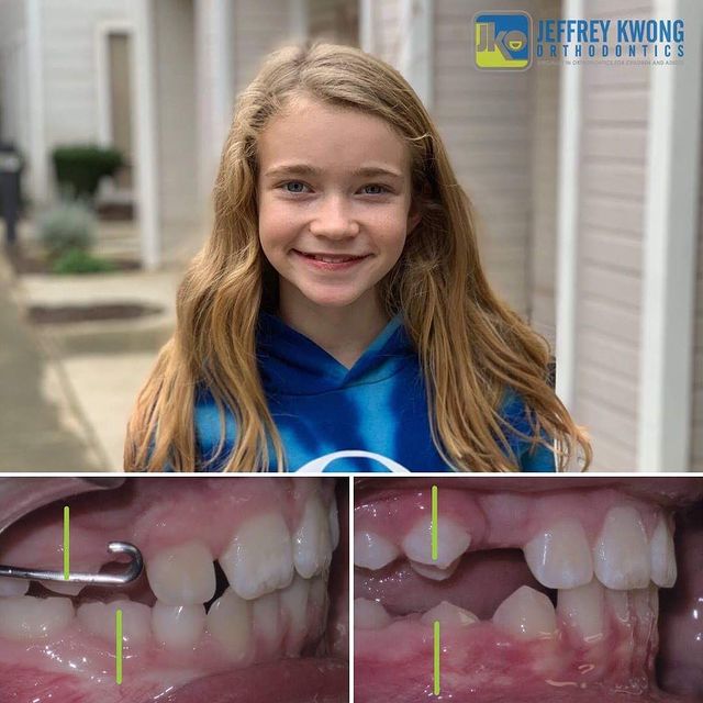 before after teeth of girl kid