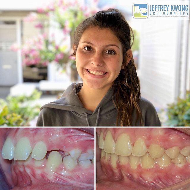 before after teeth of of young girl