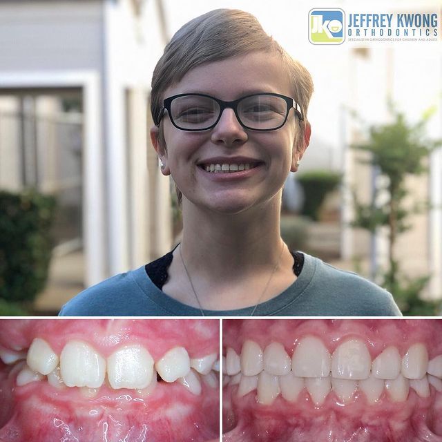 before after teeth of teen boy