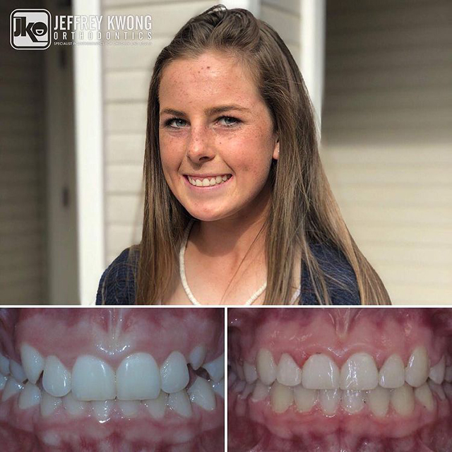 before and after teeth of girl 2