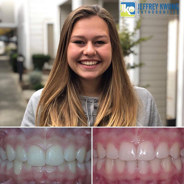 before and after teeth of girl 3