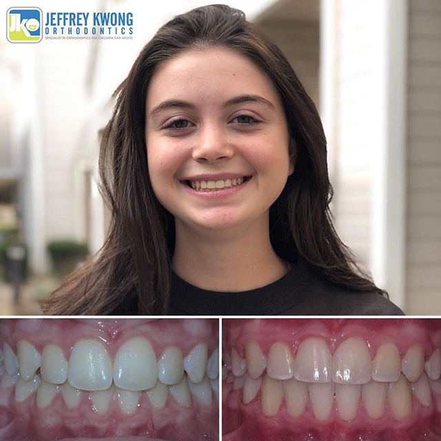 before and after teeth of young girl