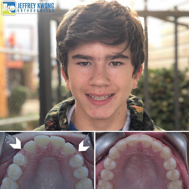 before after teeth of