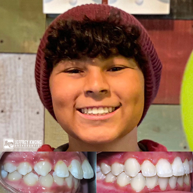 before after teeth of boy