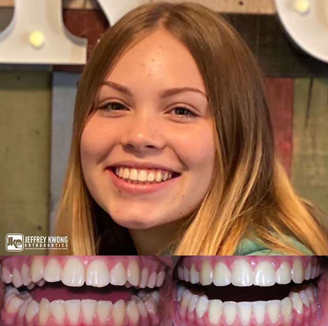 before after teeth of Girl