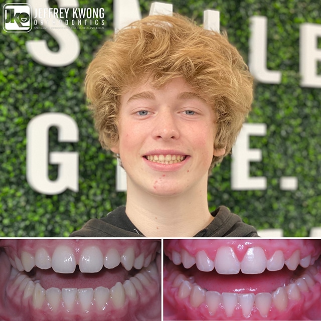 brown hair boy smiling with teeth before and after