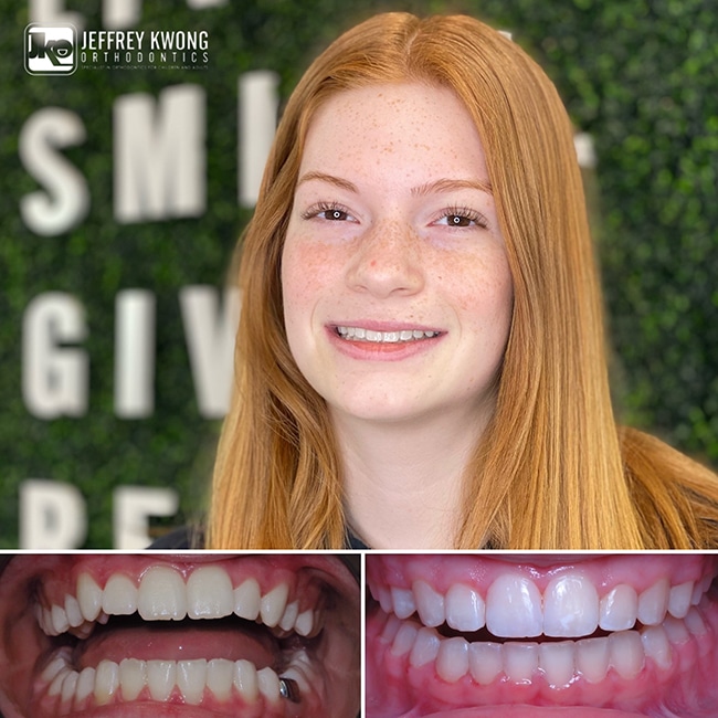 white girl smiling face with teeth before and after