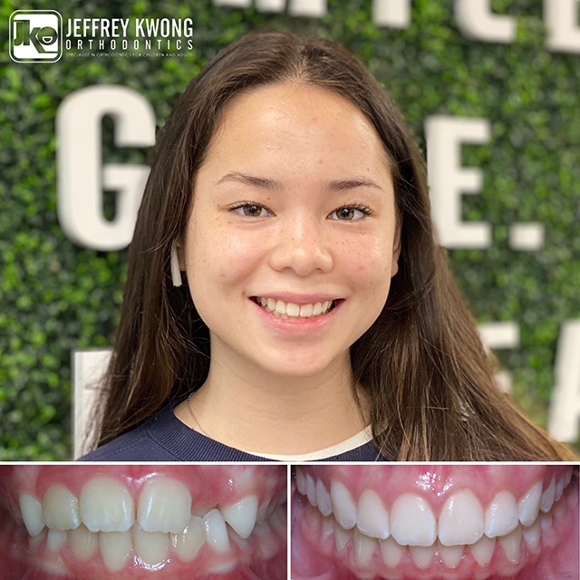 beautiful girl with teeth before and after
