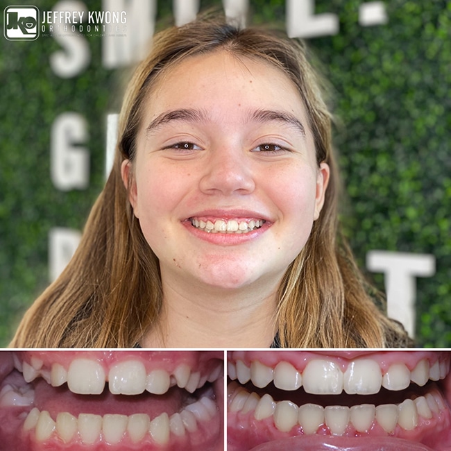 smiling girl with before and after teeth Image