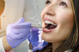 How To Whiten Your Teeth With Braces: What To Know