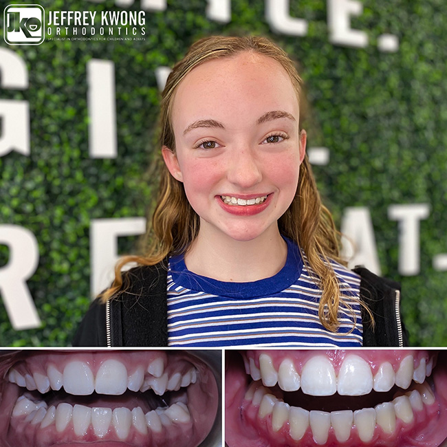 smiling girl teeth Image before and after